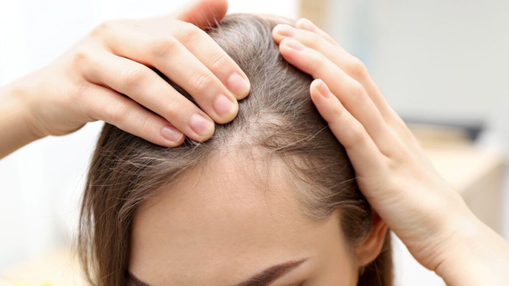 Young Woman with Hair Loss due to weight loss